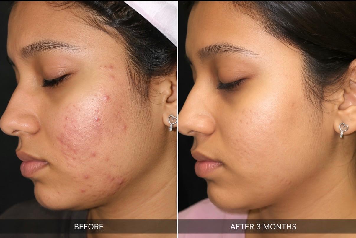 Chin Liposuction in Satara